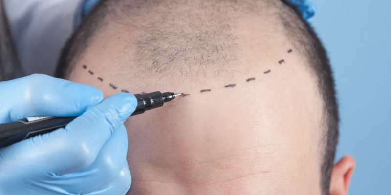 Hair Transplant Treatment Procedure