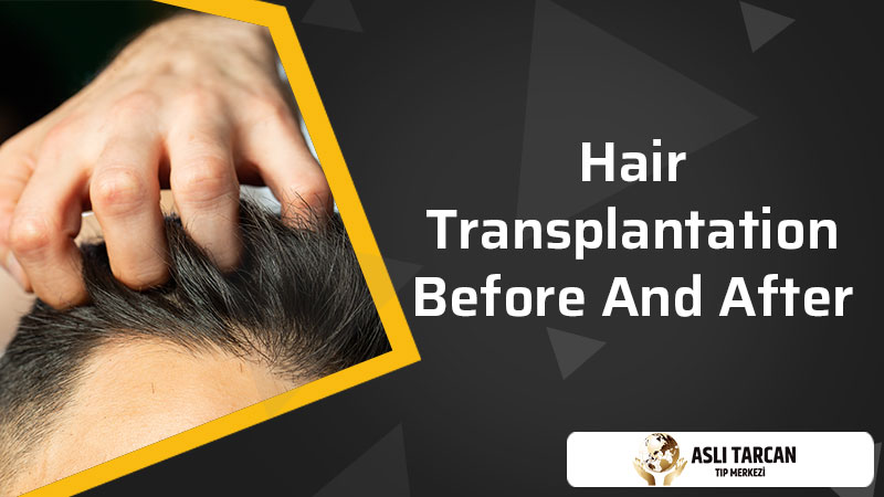 Hair Transplantation Before and After