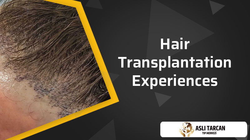 Hair Transplantation Experiences