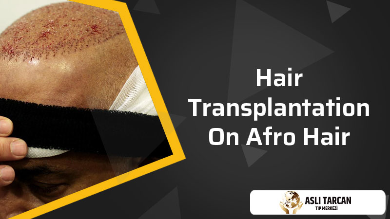 Hair Transplantation On Afro Hair