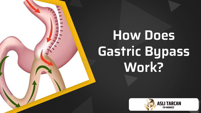 How Does Gastric Bypass Work?