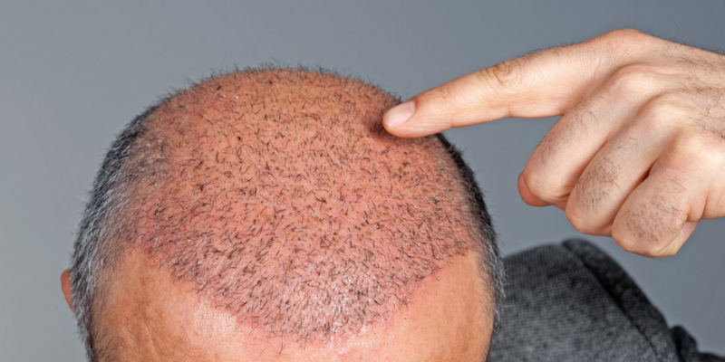 How does hair transplant work