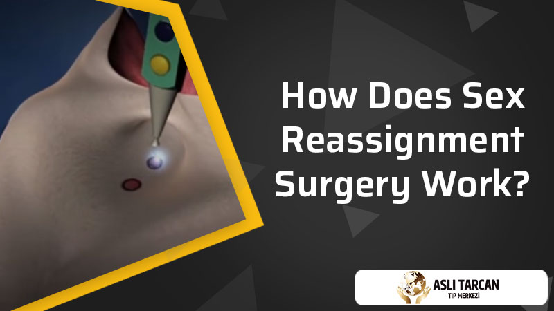 How Does Sex Reassignment Surgery Work?