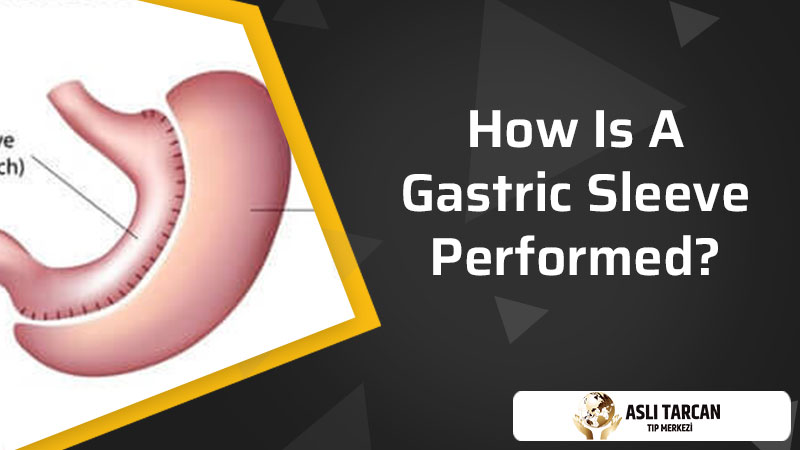 How Is A Gastric Sleeve Performed?