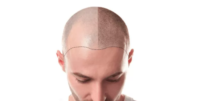 How Long After Hair Transplant Before Stubble?