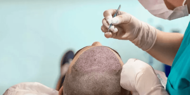 The How Long After Hair Transplant Can I Use Nizoral?