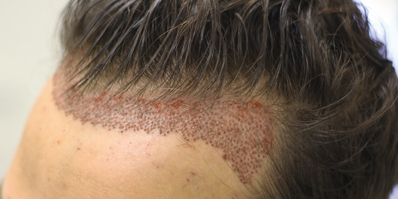How Long After Hair Transplant Donor Area Swelling Is Gone? | Aslı Tarcan