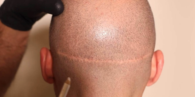 How Long After Hair Transplant Is There Full Growth?