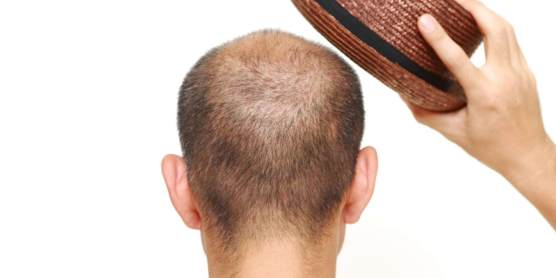 How Long After Hair Transplant Wear Hat? | Asli Tarcan Clinic