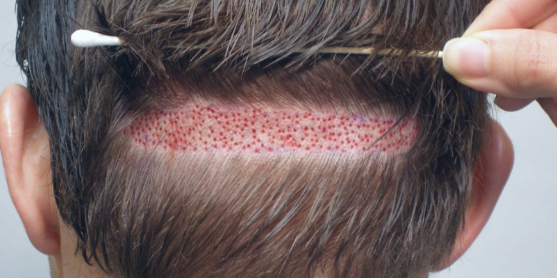 How Long Before Strip To Heal Hair Transplant FUT?