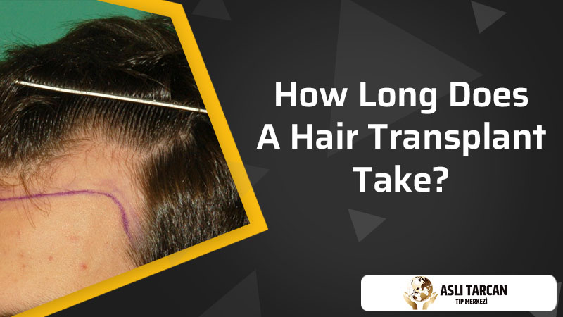 How Long Does A Hair Transplant Take?