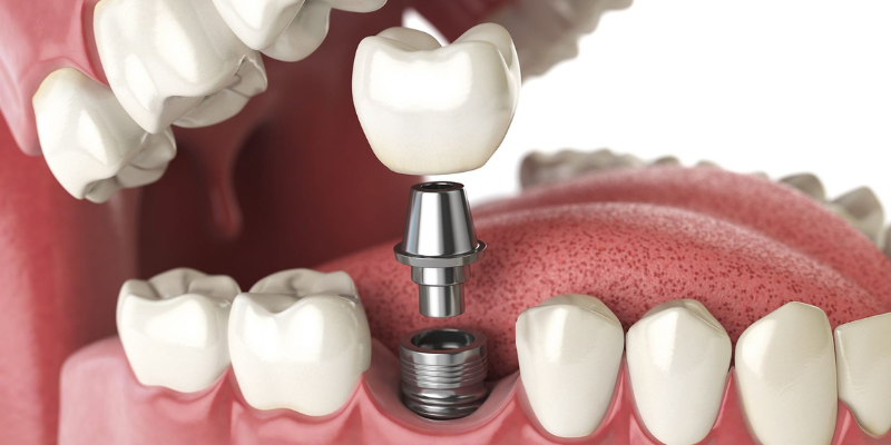 How Much Are Dental Implants?