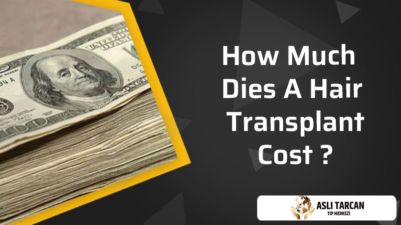 How Much Dies A Hair Transplant Cost