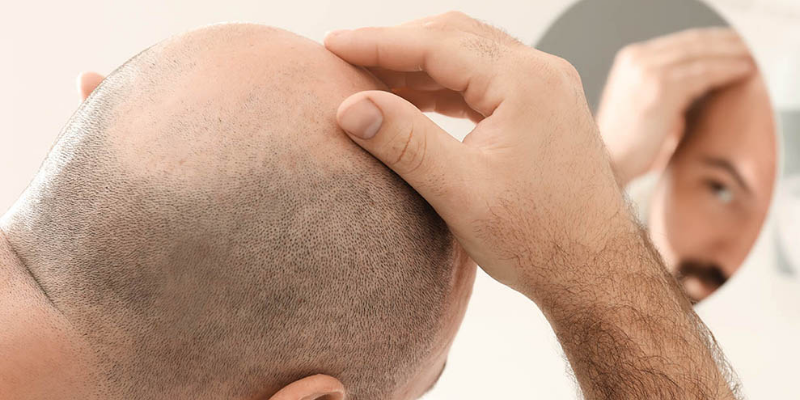How much does hair transplant cost in Turkey