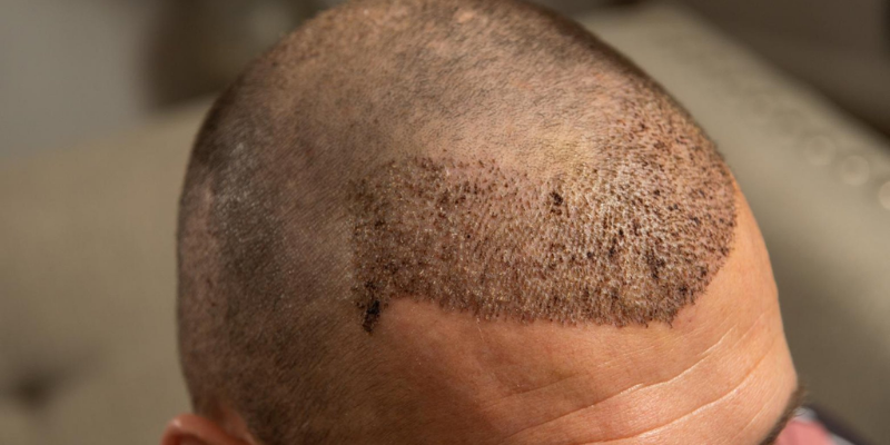 How Much Is A Hair Transplant In Turkey