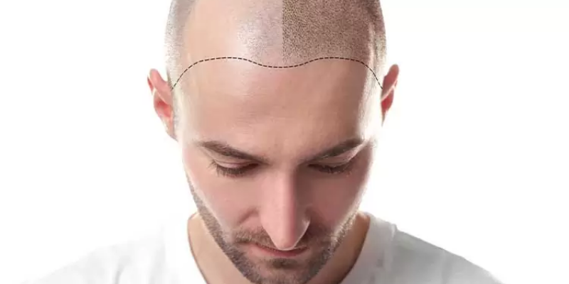 How much is a Hair Transplant in Turkey