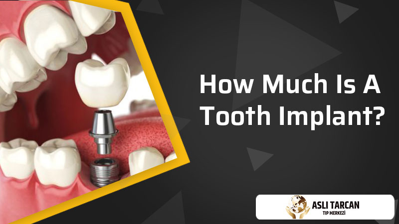 How Much Is A Tooth Implant?