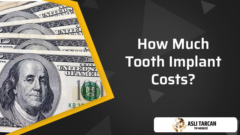 How Much Tooth Implant Costs?