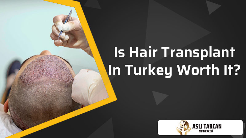 is hair transplant in turkey worth it