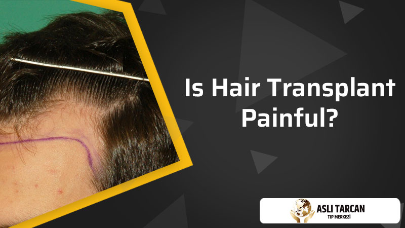 Is Hair Transplant Painful