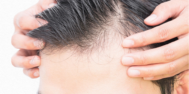 Is Hair Transplant Safe? | Asli Tarcan Clinic