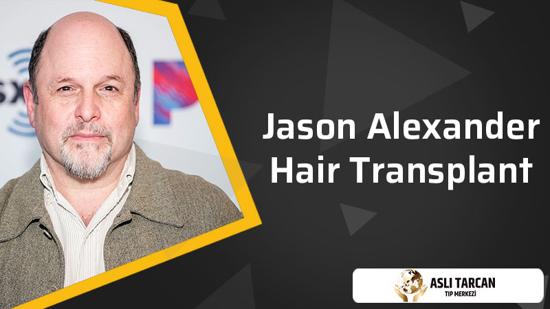 Jason Alexander Hair Transplant