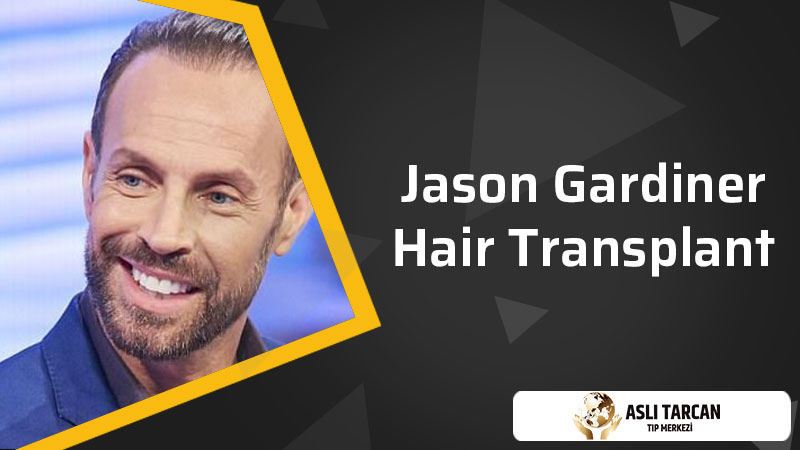 Jason Gardiner Hair Transplant