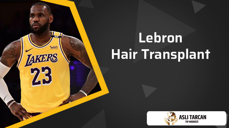 Lebron Hair Transplant