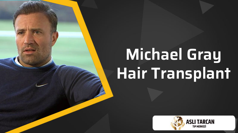 Michael Gray hair transplant