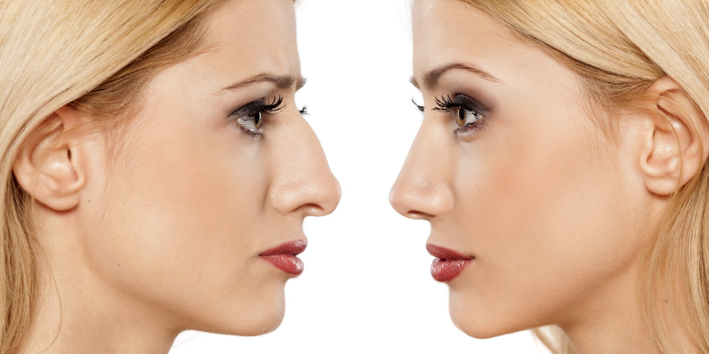 Recovery From Rhinoplasty