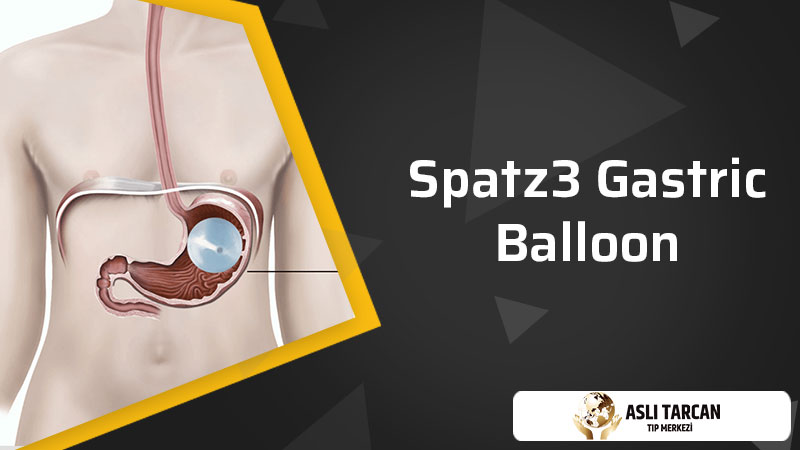 Spatz3 Gastric Balloon 
