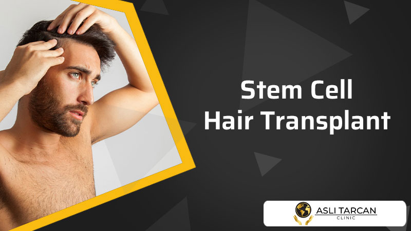 Stem Cell Hair Transplant