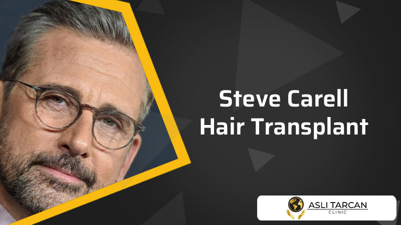 Steve Carell Hair Transplant
