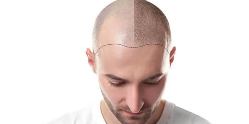 The Cost of Hair Transplant in Turkey