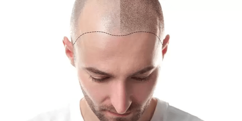 The How Long After Hair Transplant Can I Use Rogaine?