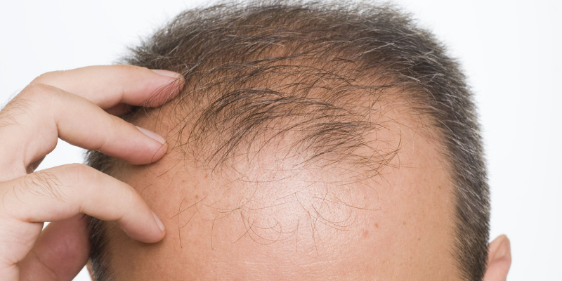 Try Guys Hair Transplant | Asli Tarcan Clinic