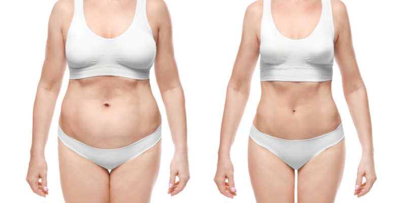 weight loss surgery scars weight loss