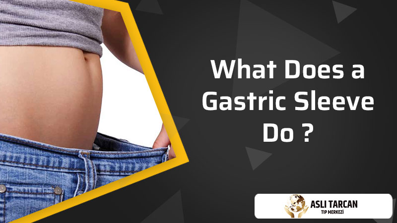 What Does a Gastric Sleeve Do