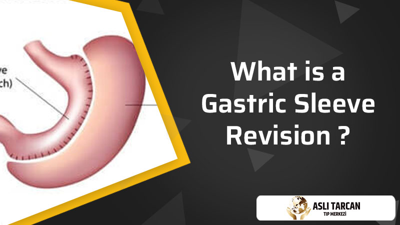 What is a Gastric Sleeve Revision