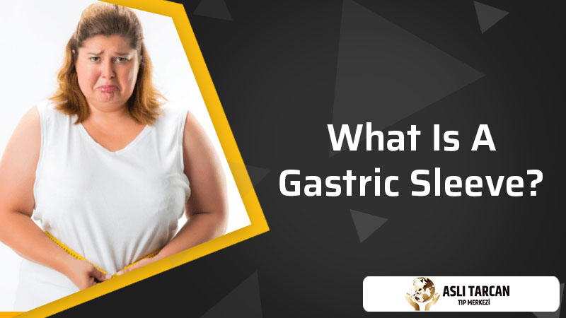 What Is a Gastric Sleeve?