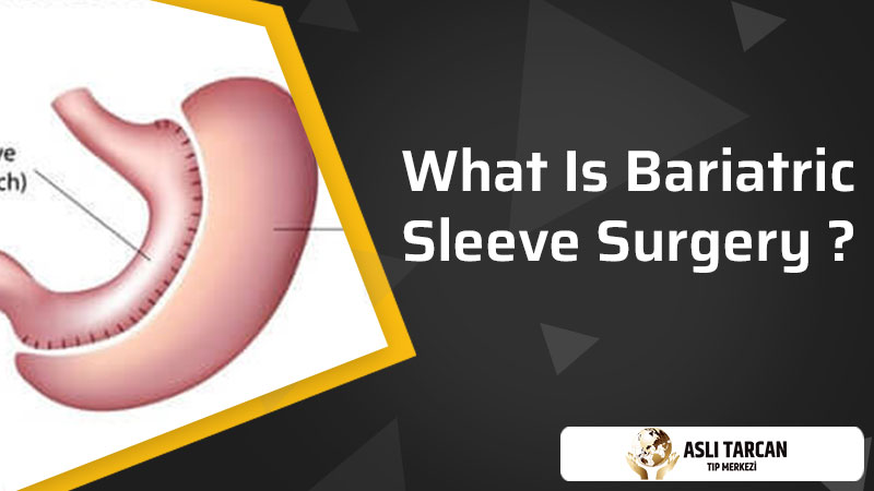 What Is Bariatric Sleeve Surgery