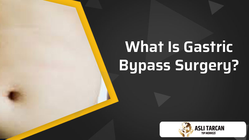 What Is Gastric Bypass Surgery?