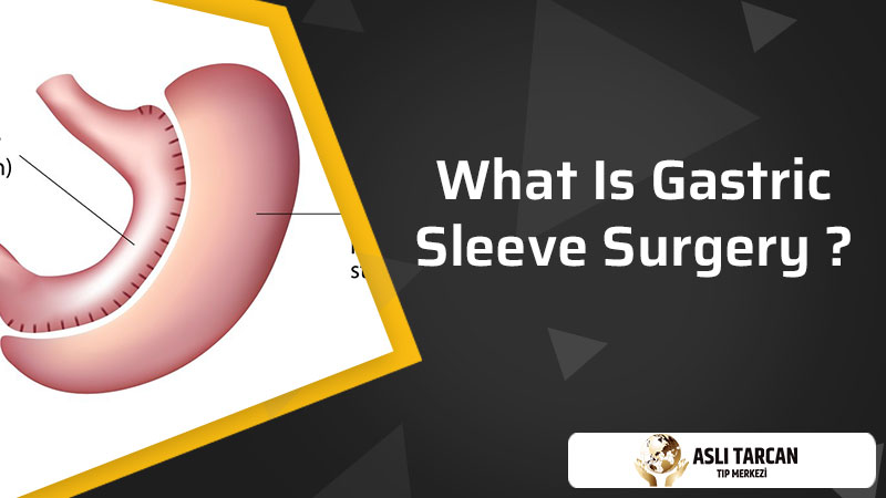 What Is Gastric Sleeve Surgery