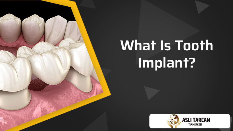 What Is Tooth Implant?
