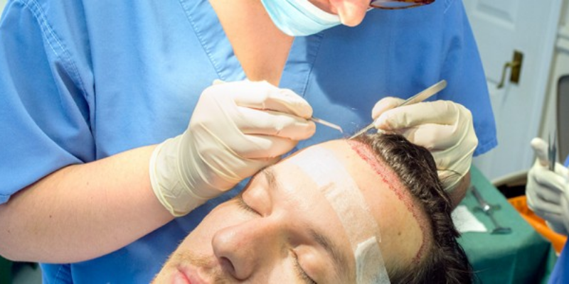 Where To Get Hair Transplant In Turkey