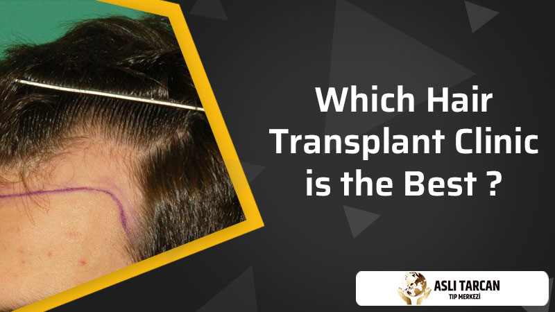 Which Hair Transplant Clinic is the Best